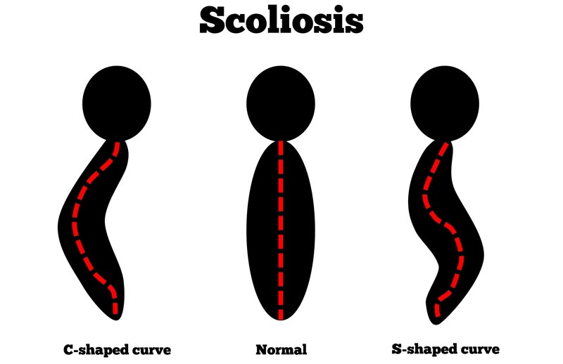 Oregon, OH scoliosis treatment